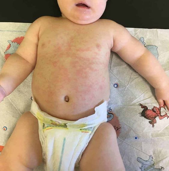Éruption cutanée chez le bébé (chaleur épineuse)