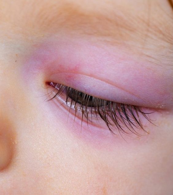 Pinkeye (conjonctivite) chez les bébés
