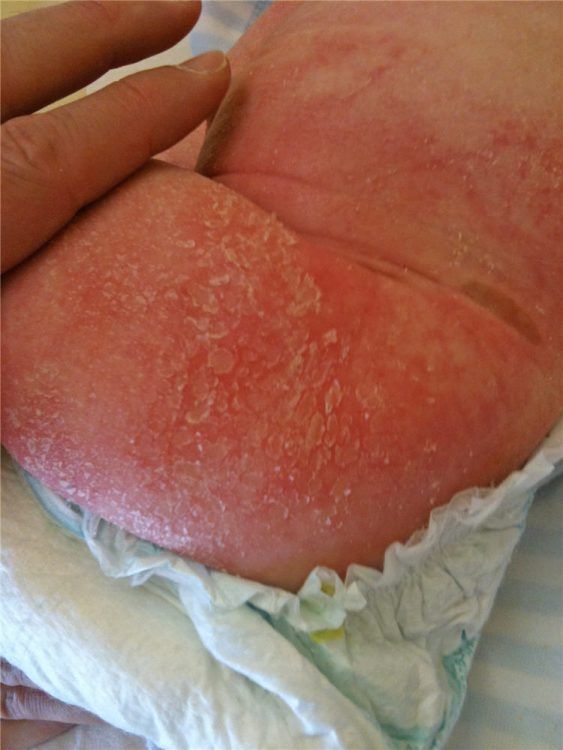 Eczéma chez les bébés et les enfants