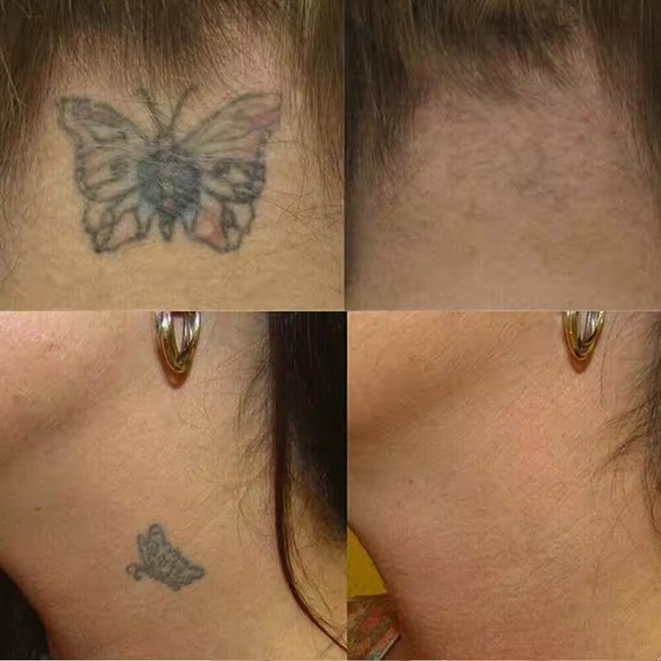 Understanding the basics of tattoo removal is key for anyone looking to erase a tattoo.
